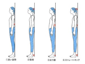 姿勢の種類：良い姿勢、猫背、反り腰、ストレートネック